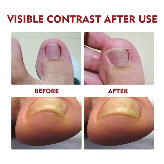 ANTI HONGOS X 2 UNIDADES - SEDealmania